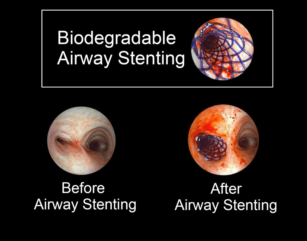 കേരളത്തിൽ ആദ്യമായി ബയോഡീഗ്രേഡബിൾ എയർവേ സ്റ്റെന്റിങ്; അമൃത ആശുപത്രിയിൽ ചരിത്രനേട്ടം